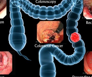 Colorectal-Cancer-picture-752x440